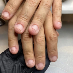 Les ongles rongés